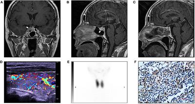 Frontiers | Concurrent Graves' Disease and TSH Secreting Pituitary